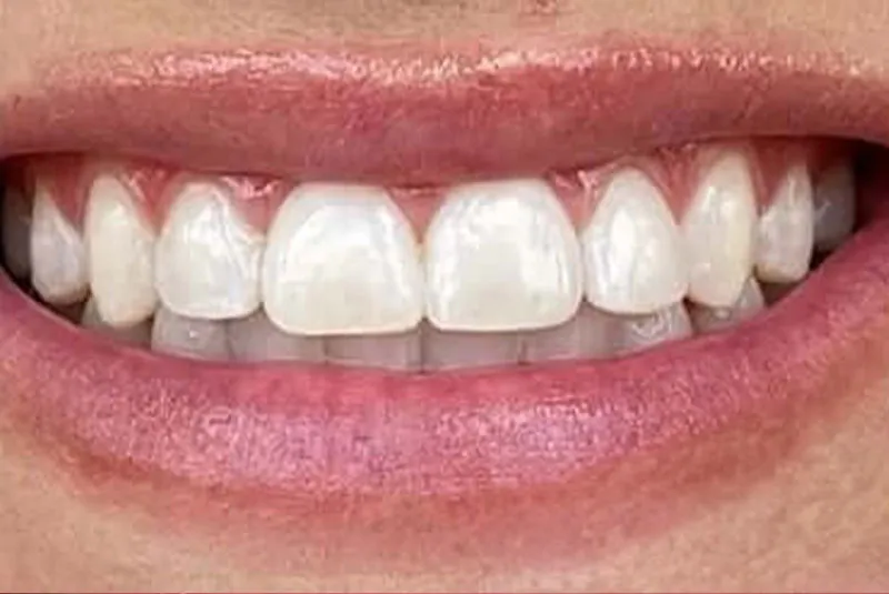 After dental implants