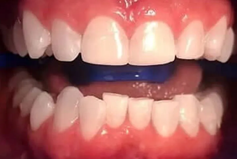After teeth whitening