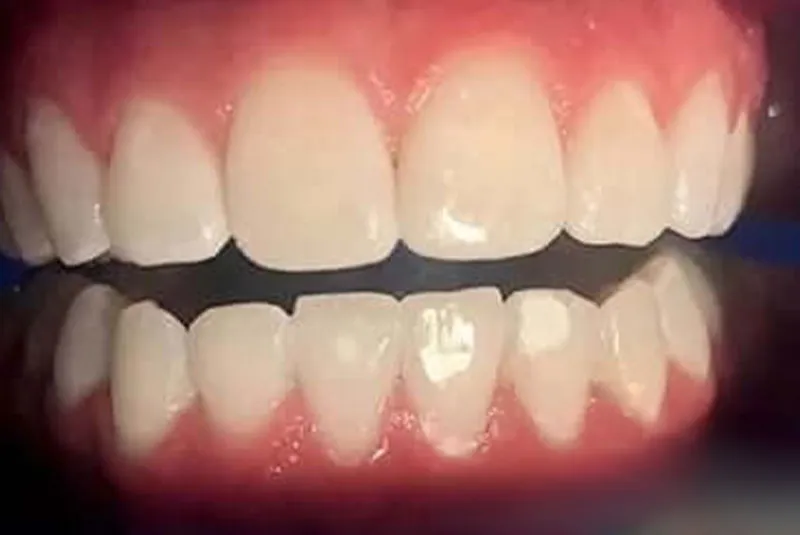 After teeth whitening