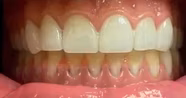 After cosmetic dentistry
