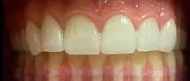 After dental implants