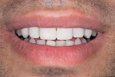 After dental bonding