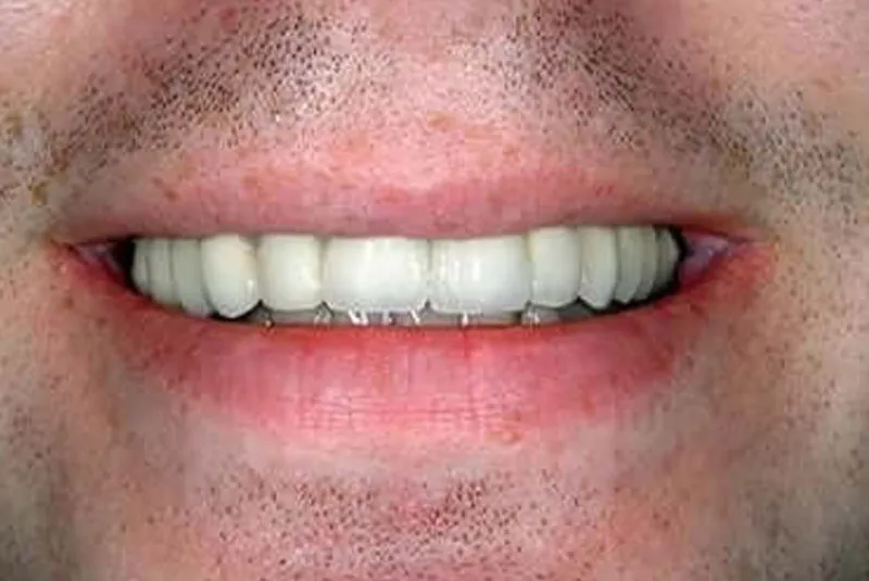 After dental implants