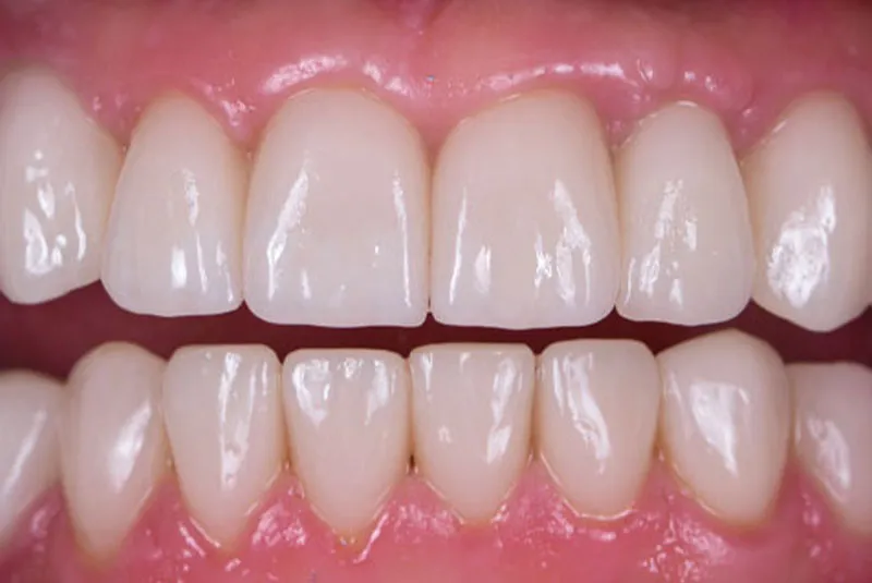 After dental implants