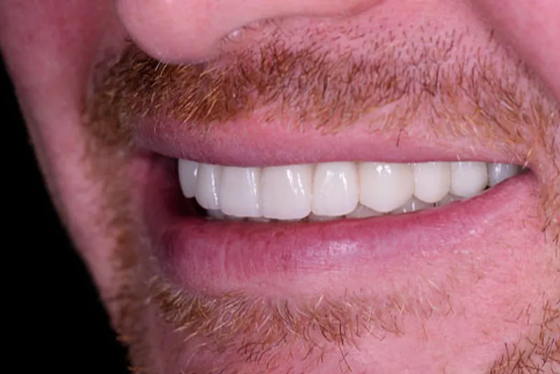 After dental implants