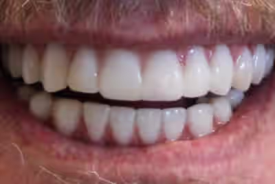 After dental implants