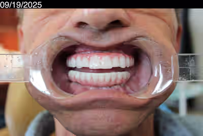After dental implants