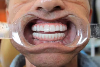 Patient smile after dental implant treatment at Halls Family Dentistry