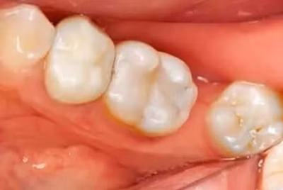 After tooth-colored filling