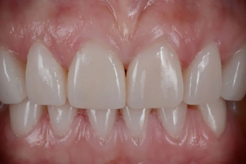 After porcelain veneers