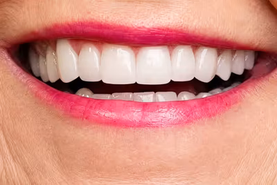 Patient smile after porcelain veneers at Halls Family Dentistry