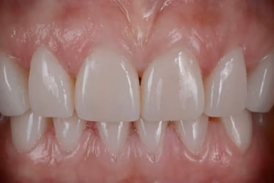 After porcelain veneers