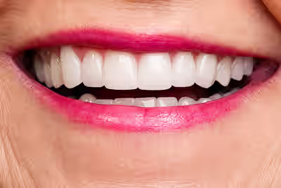 After porcelain veneers