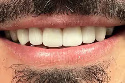 After porcelain veneers