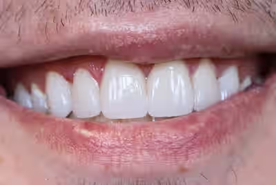 After porcelain veneers