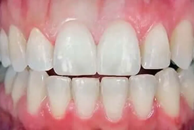 After dental implants