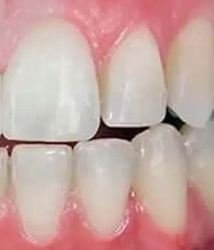 After dental implants