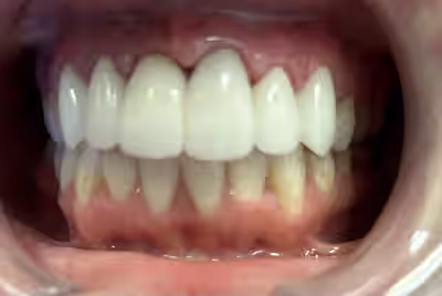After porcelain veneers