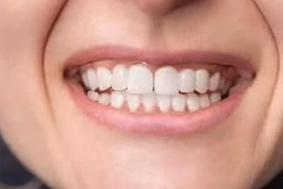 Patient smile after restorative dental treatment at Halls Family Dentistry