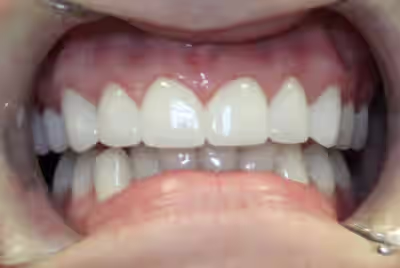 After teeth whitening