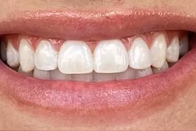 Patient smile after professional teeth whitening at Halls Family Dentistry