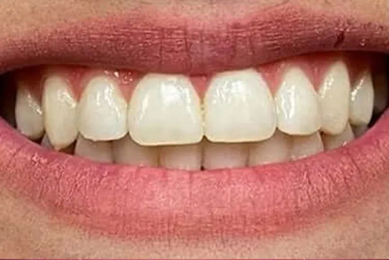 Before dental implants