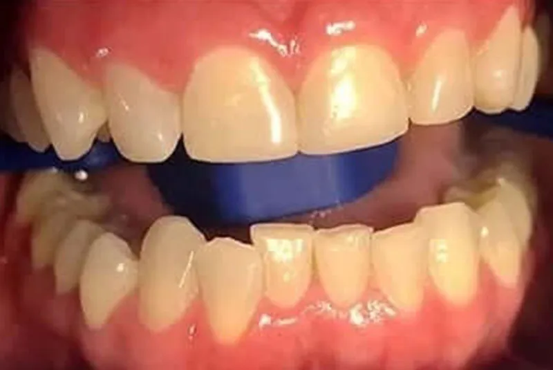 Before teeth whitening