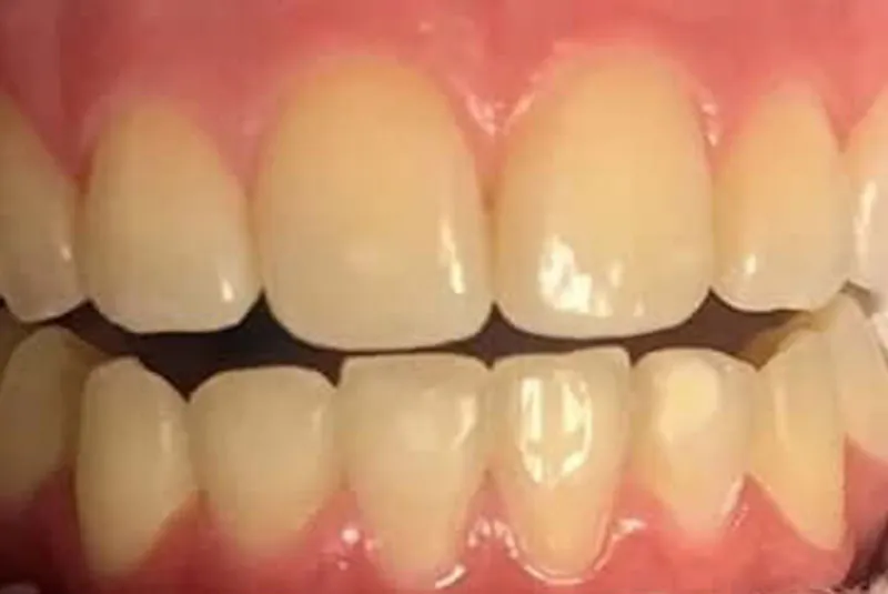 Before teeth whitening