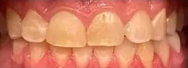 Before dental implants