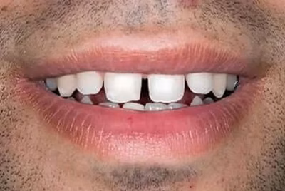 Before dental bonding