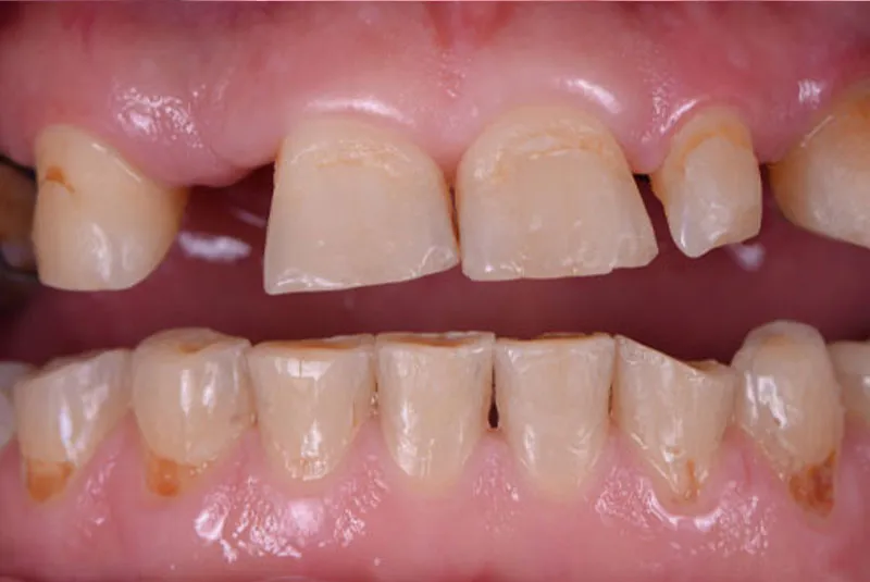 Before dental implants