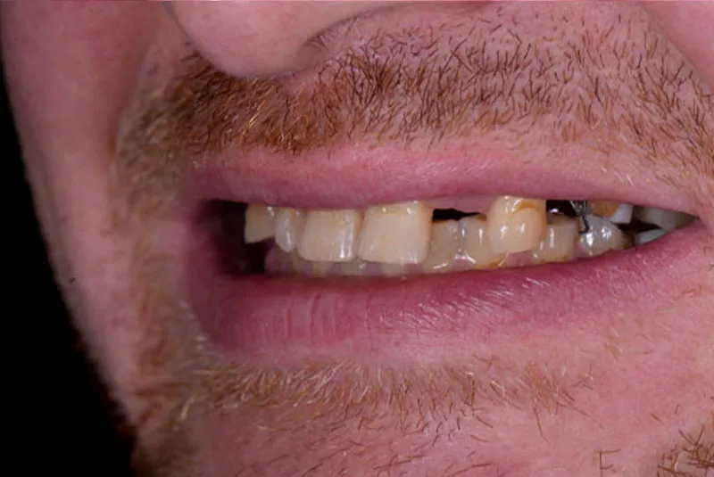 Before dental implants