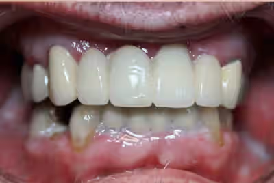 Before dental implants