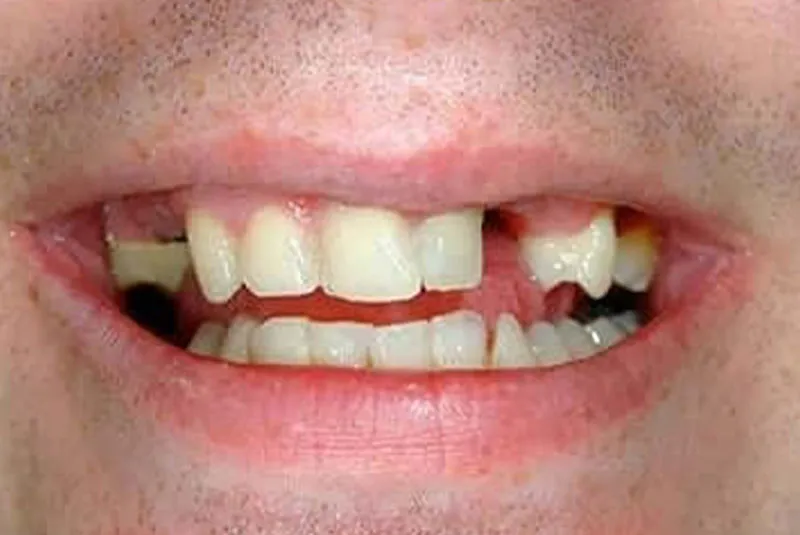 Before dental implants