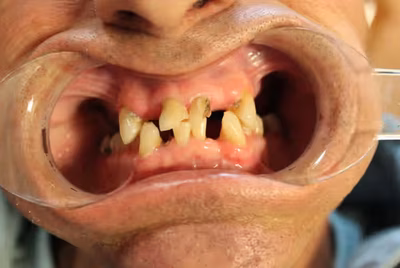Patient smile before dental implant treatment, showing missing teeth
