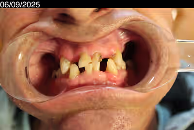 Before dental implants