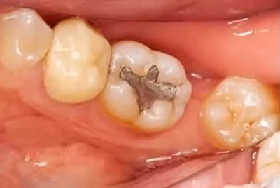 Before tooth-colored filling