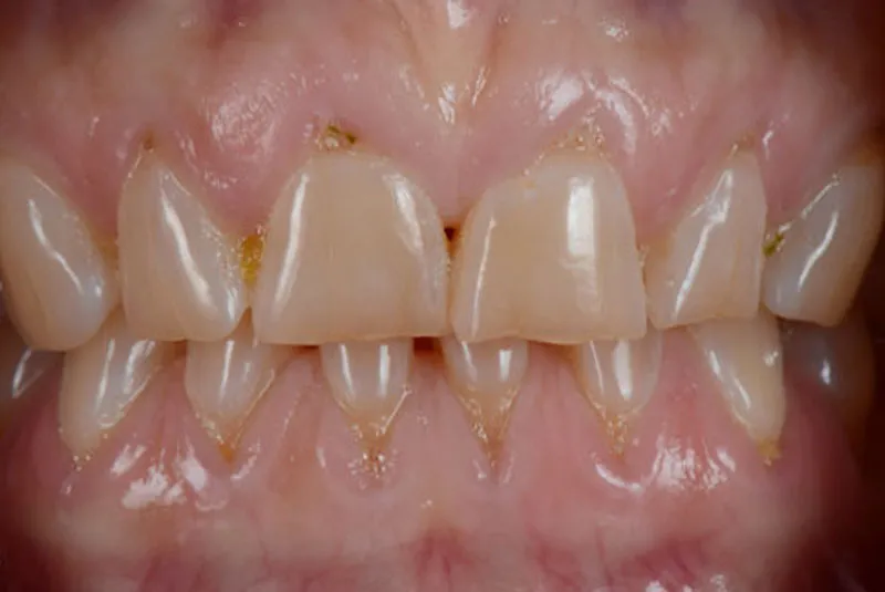 Before porcelain veneers