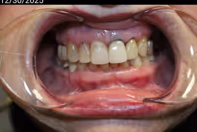 Before porcelain veneers