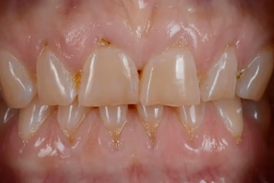 Before porcelain veneers