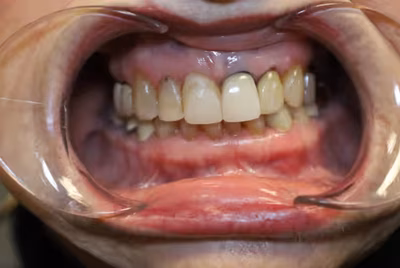 Patient smile before porcelain veneers, showing chipped and discolored teeth