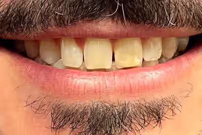 Before porcelain veneers
