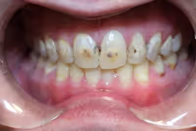 Before porcelain veneers