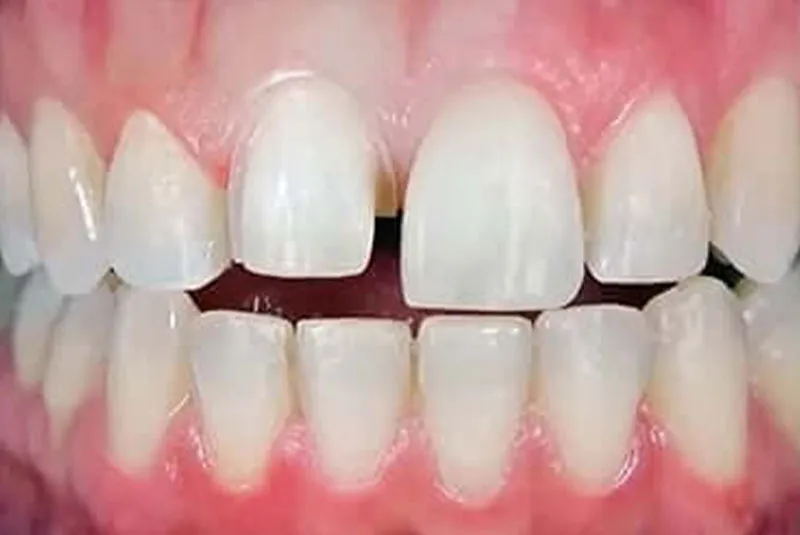 Before dental implants