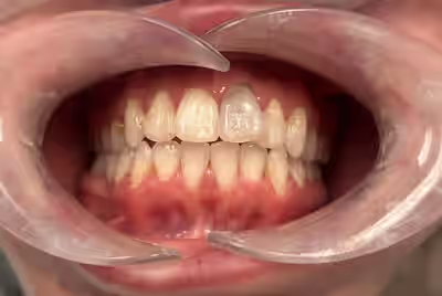 Before porcelain veneers