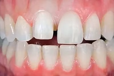 Before porcelain veneers