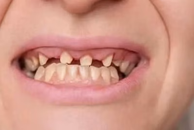 Patient smile before restorative dental treatment, showing damaged teeth