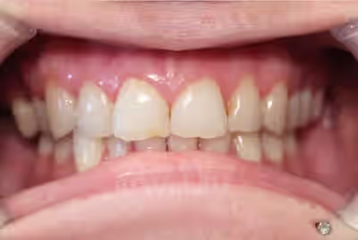 Before teeth whitening