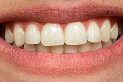 Patient smile before professional teeth whitening, showing stained teeth