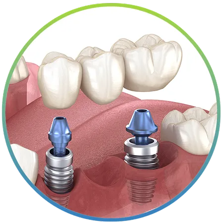 3D model of an implant-retained dental bridge